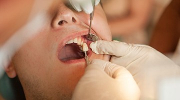 Die neue Zahnkrone wird individuell, natürlich und nach Patientenwunsch vorbereitet.