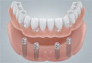 Hybrid Zahnversorgung