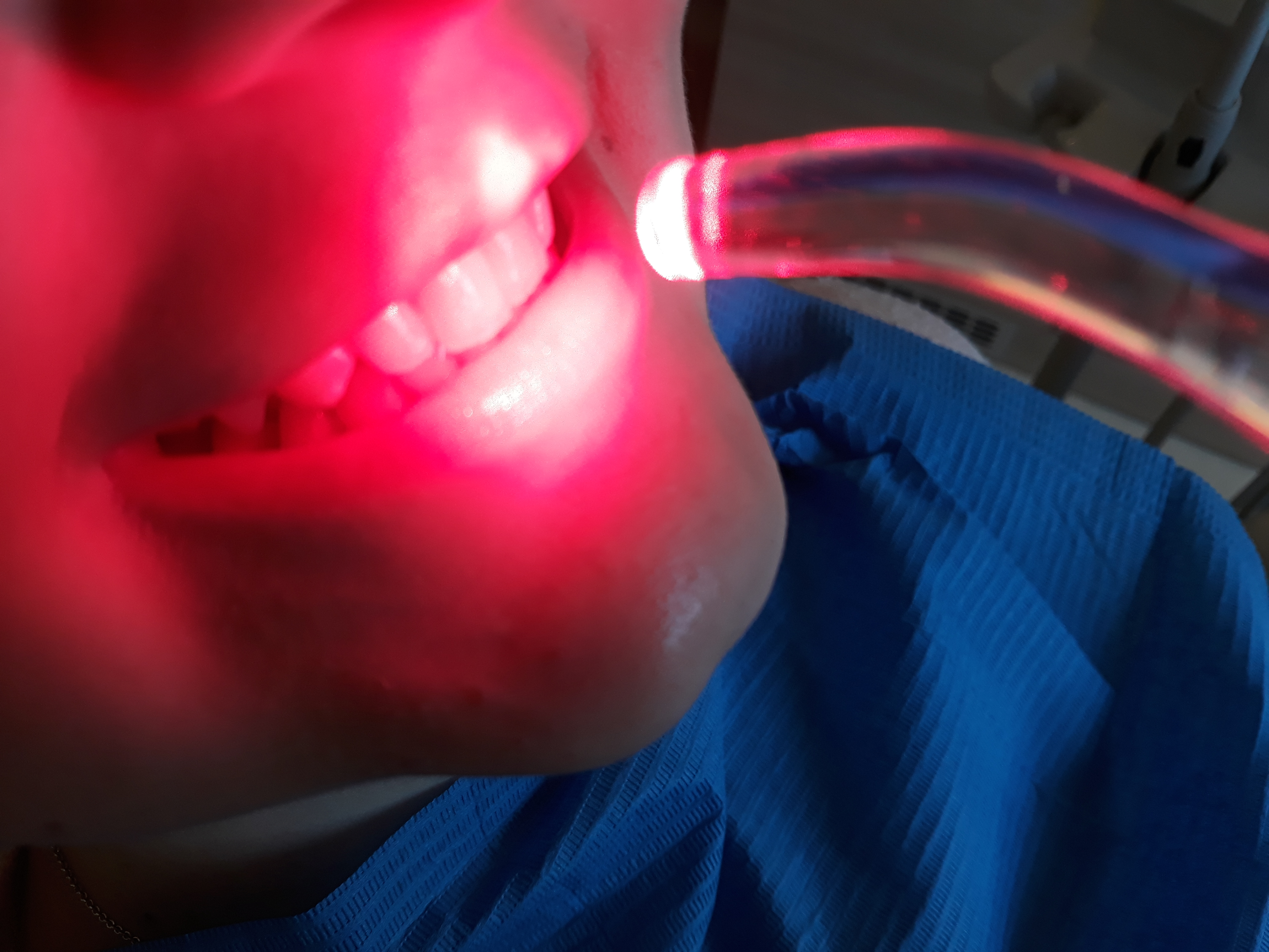 Soft-Laser Behandlungen - Zahnarzt