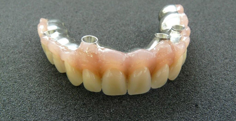 Zahnbrücke auf Implantaten