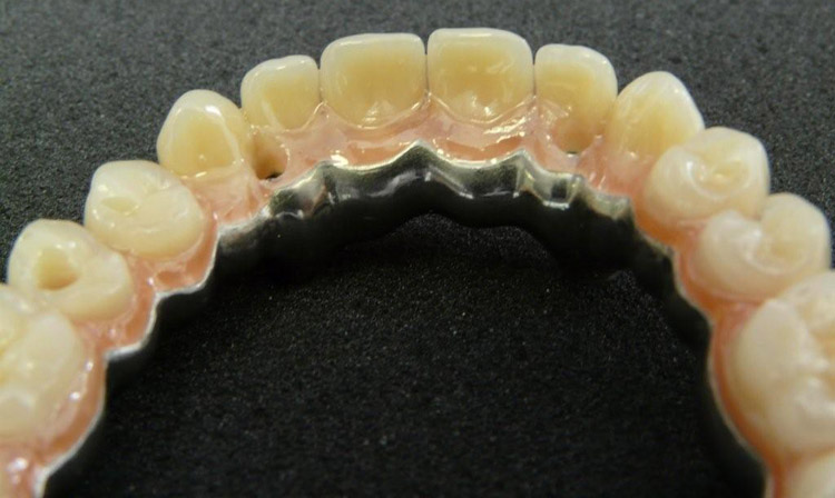Zahnbrücke auf Implantaten befestigt