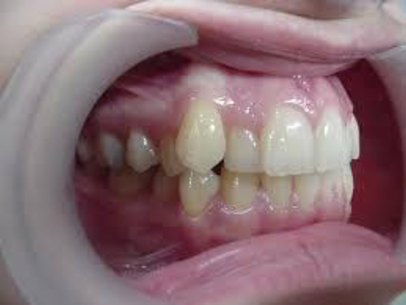 Zahnbild ohne  Zahnregulierung