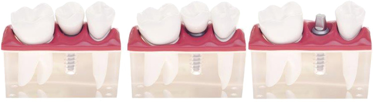 Zahnersatz bei ein fehlende Zahn
