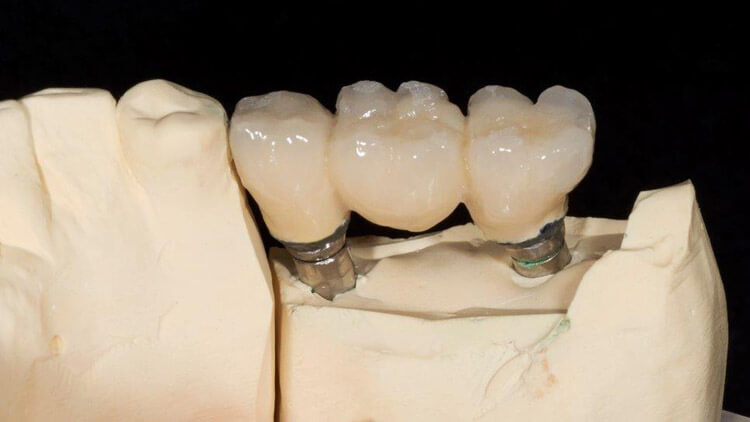 Zahnimplantate bei mehreren fehlenden Nachbarzähnen