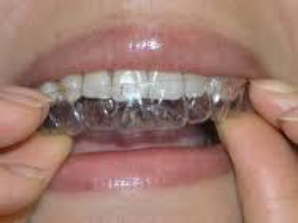 Zahnregulierung mit transparenten Zahnspangen